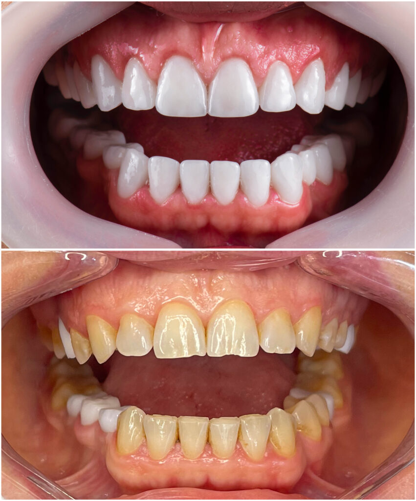 crowns veneers implants